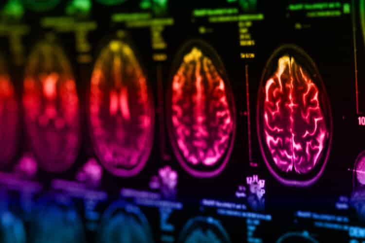 5 lifestyle changes to prevent dementia